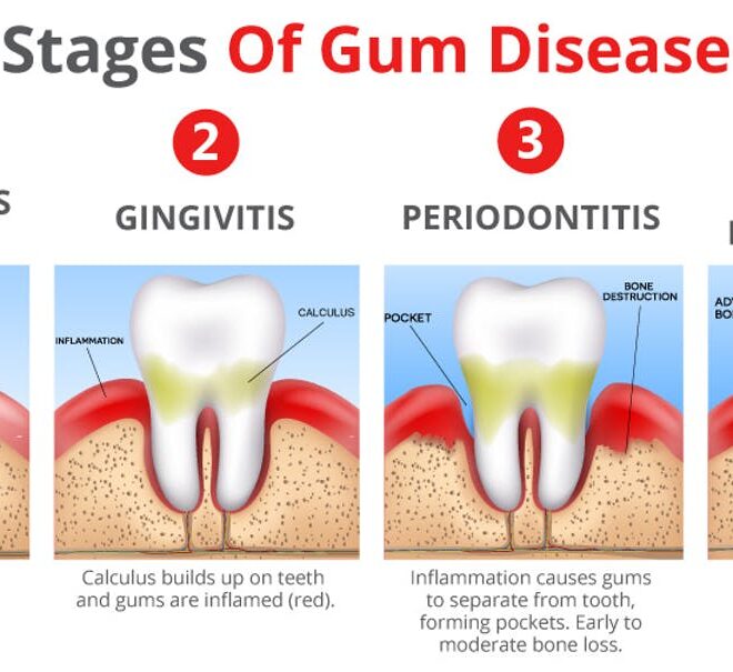 Gum Disease (Periodontal Disease): Overview, Causes, Symptoms & Care
