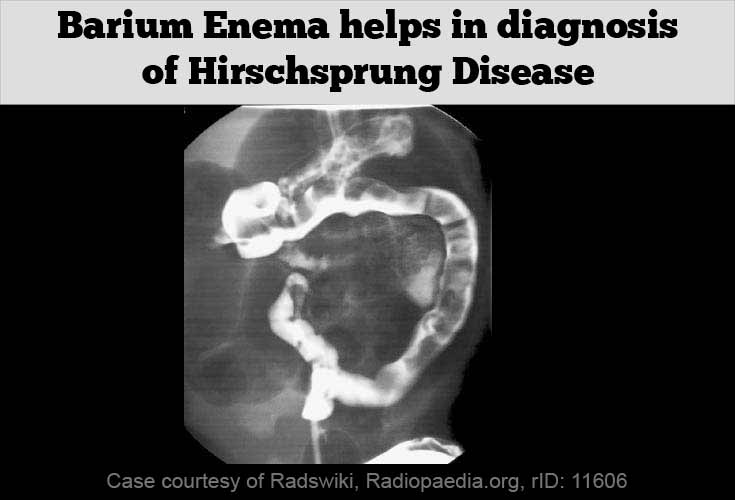 Hirschsprung's Disease (Congenital Megacolon): Overview, Symptoms, Diagnosis & Treatment