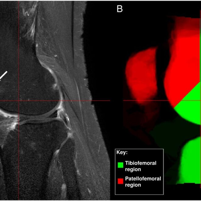 Knee Pain Around the Kneecap (Patellofemoral Pain Syndrome): Overview
