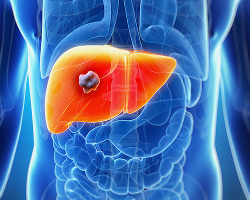 Liver Cancer: Types, Causes, Symptoms, and Treatments