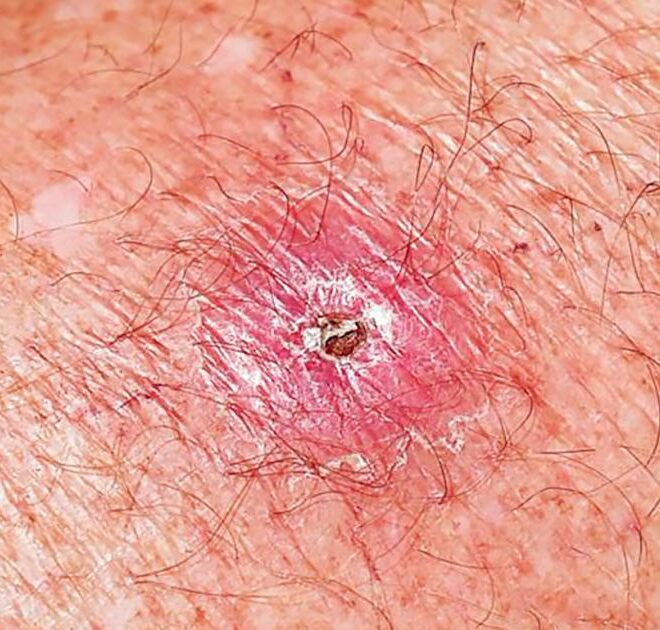 Necrotizing Fasciitis (Flesh-Eating Disease): Causes, Symptoms, Diagnosis, and Treatment