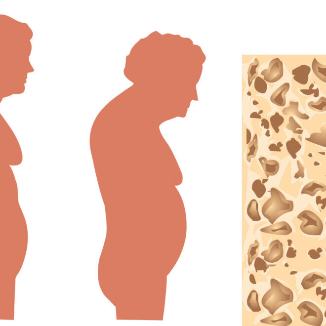 Osteoporosis: A Complete Guide to Understanding Bone Loss