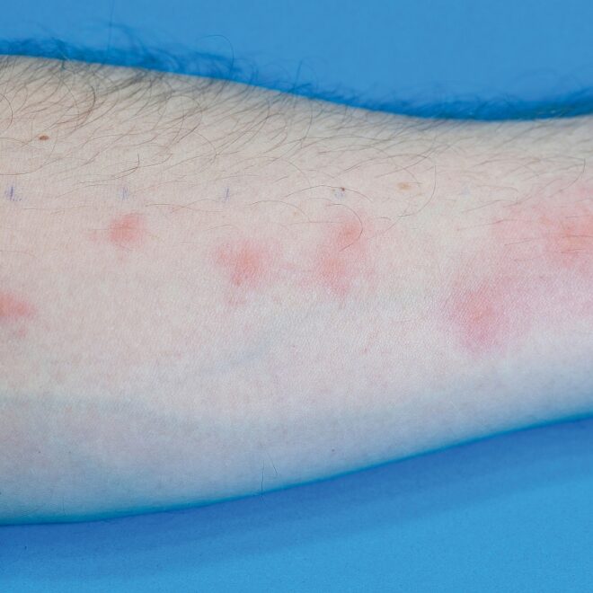 Bed Bug Bites: Symptoms, Causes, and Treatment Options