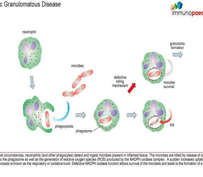 Chronic Granulomatous Disease (CGD): Overview, Causes, Symptoms & Care
