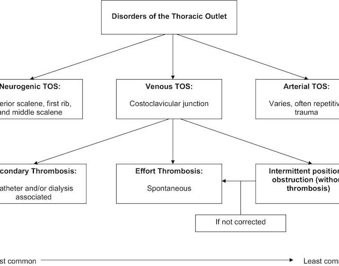 Thoracic Outlet Syndrome: Understanding the Condition, Its Causes, and Treatments