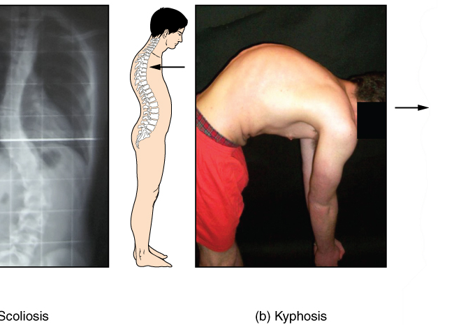 Kyphosis: An Overview of the Curved Upper Back Condition (Hyperkyphosis)