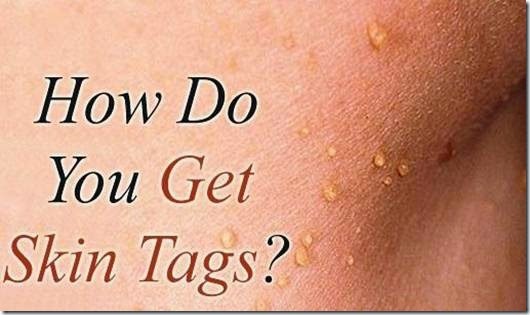 Skin Tags: Overview, Causes, Removal Options