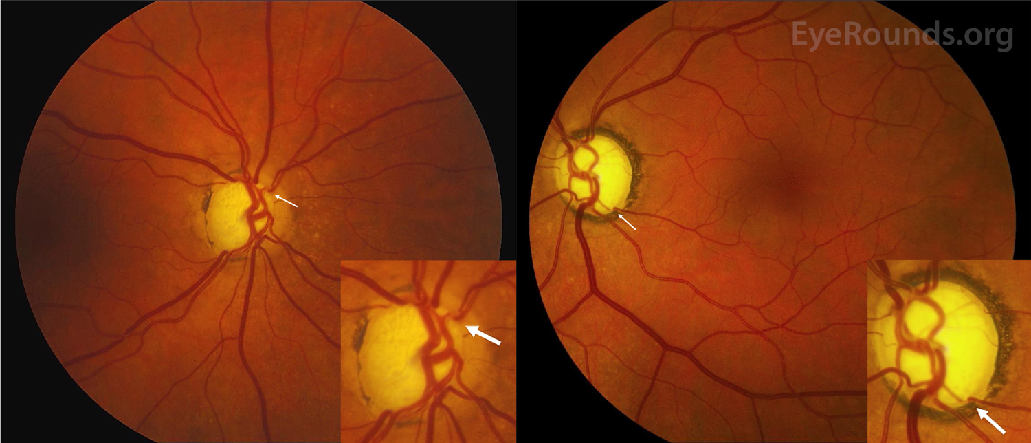 Glaucoma: Causes, Symptoms, and Treatments
