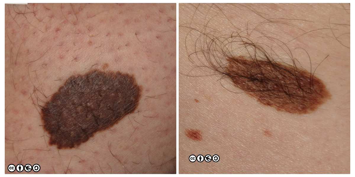 Moles (Melanocytic Nevus): Types, Causes, Diagnosis & Removal