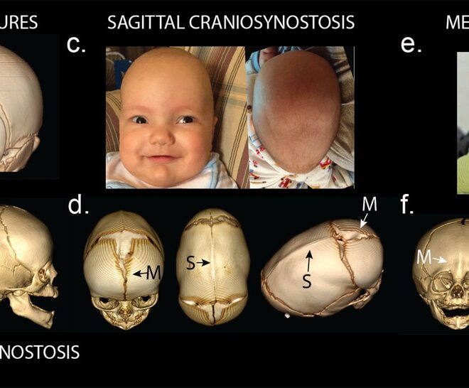 Craniosynostosis: A Detailed Overview of Premature Skull Fusion