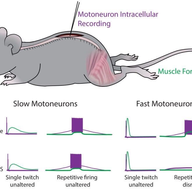 Amyotrophic Lateral Sclerosis (ALS): A Complete Overview