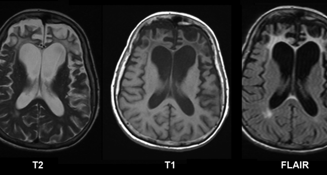 Pick’s Disease: A Guide to Frontotemporal Dementia