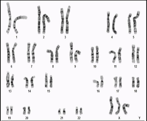 Triple X Syndrome (Trisomy X): A Complete Overview