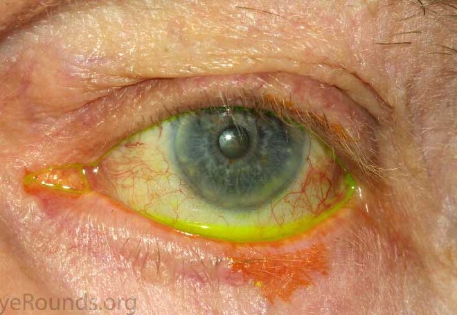 Ectropion: Understanding the Eyelid Condition, Its Causes, Symptoms & Care