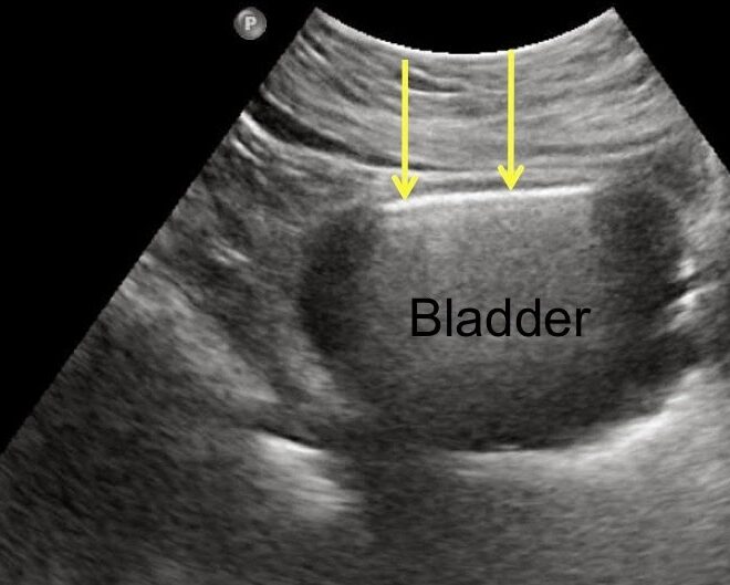 Bladder Infection (Cystitis): Causes, Symptoms, and Treatments