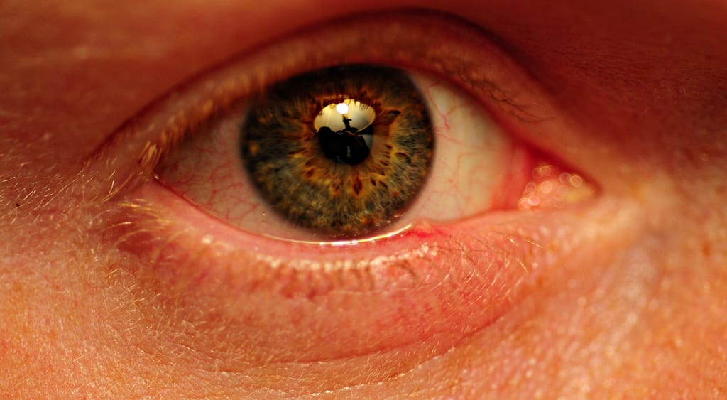 Stye (Eyelid Bump): Causes, Symptoms, and Treatments