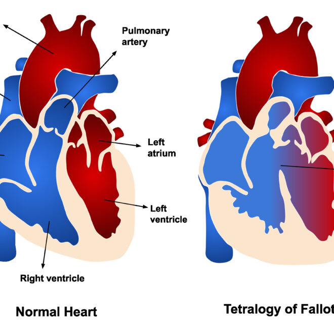 Tetralogy of Fallot (TOF): Overview, Causes, Symptoms & Treatments