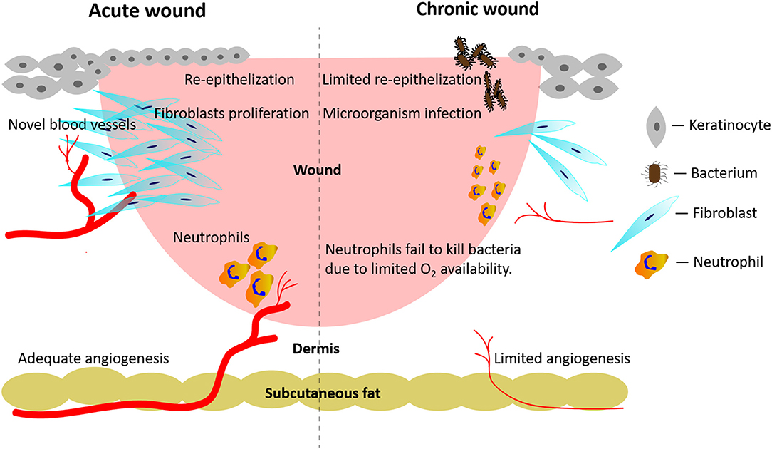 Chronic Wounds: Types, Causes, and Healing Process