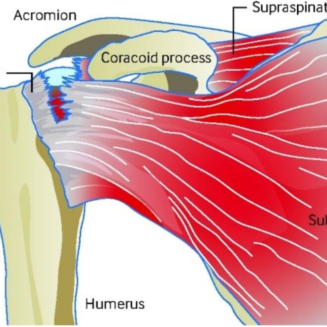 Rotator Cuff Tear: Causes, Symptoms, Diagnosis, and Treatment Options