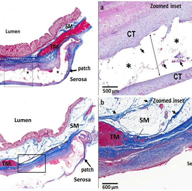 Diverticulitis: Causes, Symptoms, and Treatments