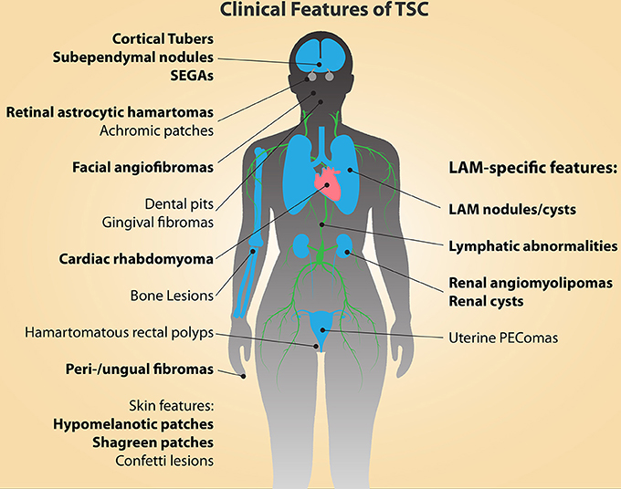Tuberous Sclerosis: A Detailed Overview of Symptoms, Diagnosis, and Treatments
