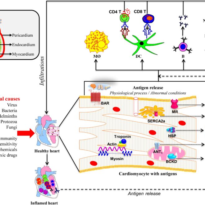Pericarditis: Understanding Inflammation of the Heart Lining (Pericardium)