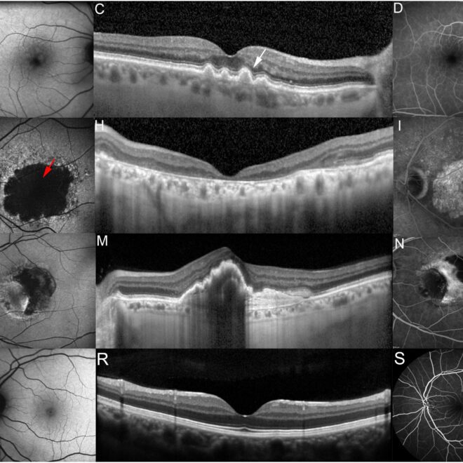 Macular Degeneration: Overview, Types, Causes, and Treatments