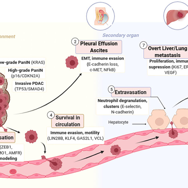 Pancreatic Cancer: Causes, Symptoms, Diagnosis, and Treatments