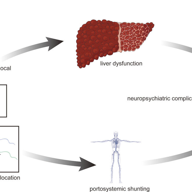 Liver Brain Disorder (Hepatic Encephalopathy): Causes, Symptoms & Care