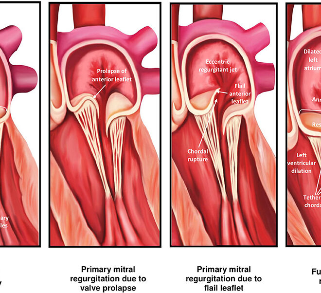 Rectal Prolapse: Causes, Symptoms, Diagnosis, and Treatments