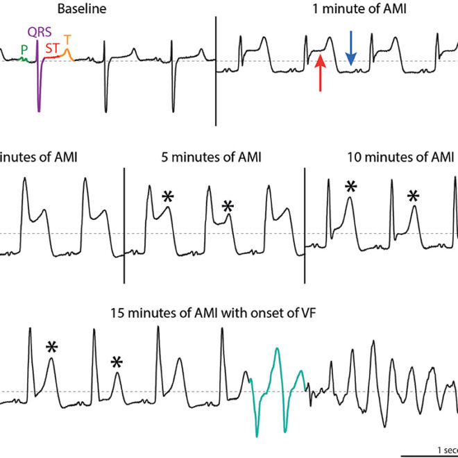 Ventricular Tachycardia: Causes, Symptoms, Diagnosis & Treatment