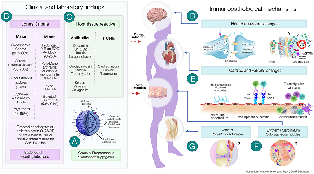 Rheumatic Fever: Causes, Symptoms, Diagnosis, and Treatment