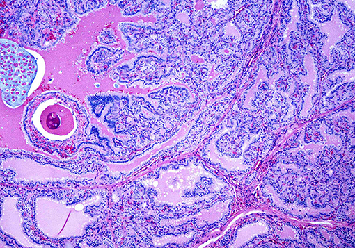 Overactive Thyroid Gland (Hyperthyroidism): Symptoms, Diagnosis, and Treatments