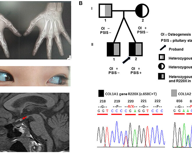 Osteogenesis Imperfecta: A Detailed Overview of Brittle Bone Disease