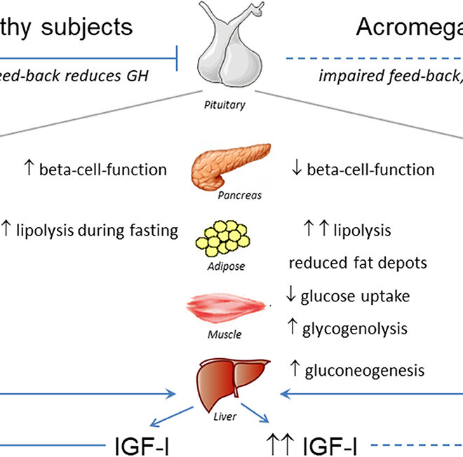 Acromegaly: Causes, Symptoms, Diagnosis, and Treatment (Growth Hormone Disorder)