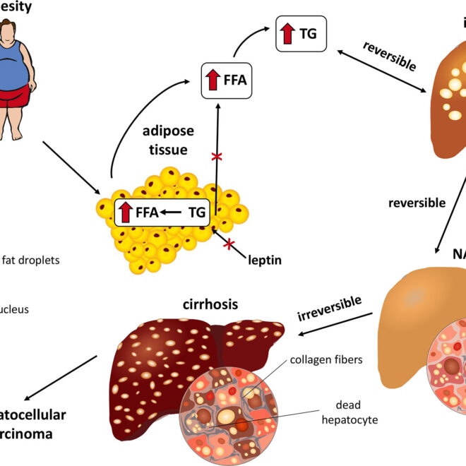 Fatty Liver Disease: Causes, Types, Symptoms, and Treatment Options