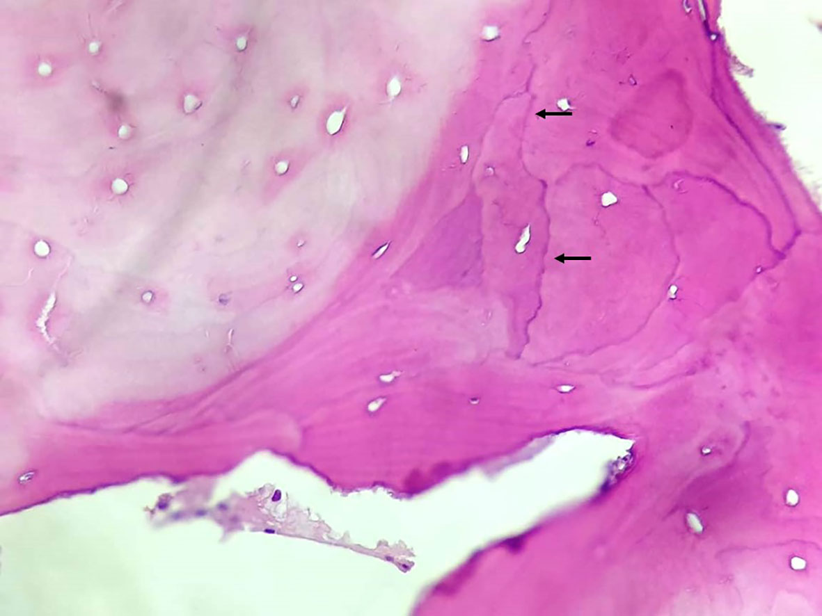 Paget's Disease of Bone (Osteitis Deformans): Overview, Causes, Symptoms & Treatment