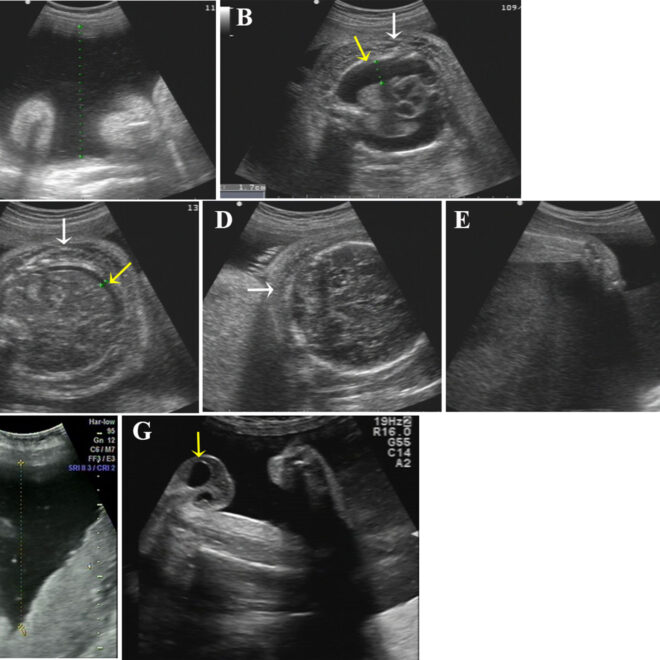 Excess Amniotic Fluid (Polyhydramnios): Causes, Symptoms, Diagnosis & Management