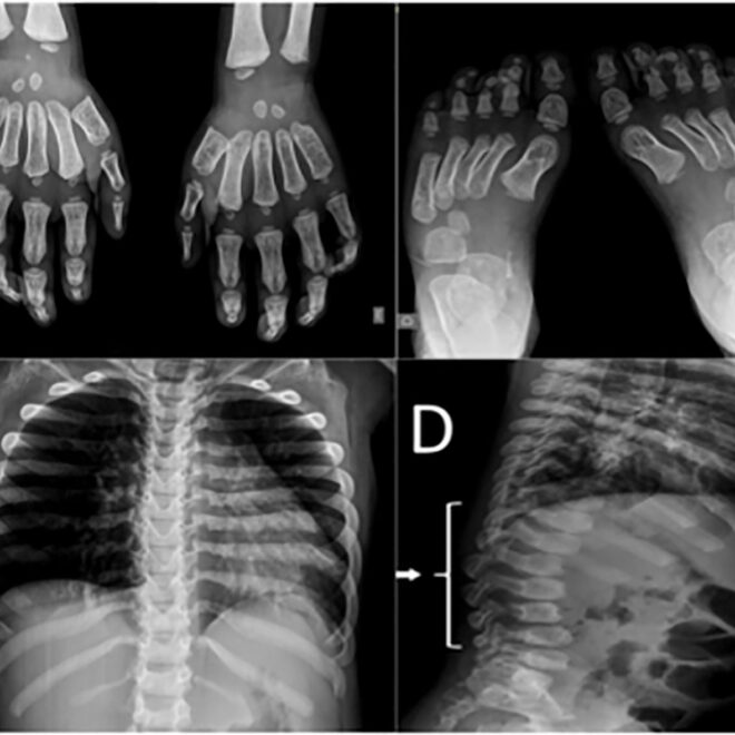 Hunter Syndrome: Understanding the Rare Genetic Disorder (Mucopolysaccharidosis II)