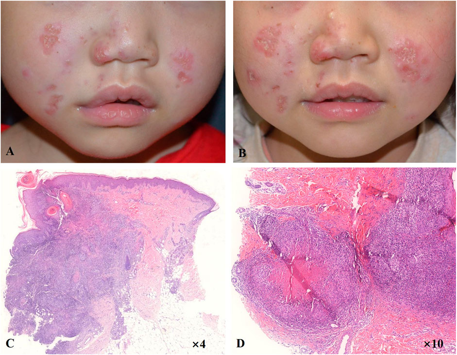 Measles (Rubeola): Symptoms, Causes, Transmission, and Prevention