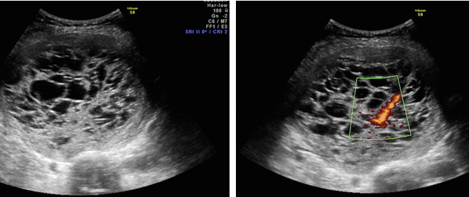 Uterine Fibroids: Overview, Types, Symptoms & Treatments