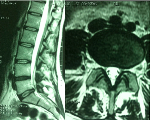 Herniated Disc (Slipped Disc): Overview, Causes, Symptoms & Treatments