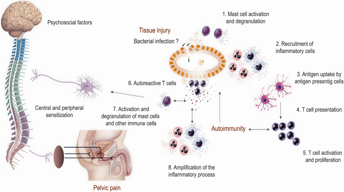 Pelvic Inflammatory Disease (PID): Causes, Symptoms, Diagnosis, and Treatment