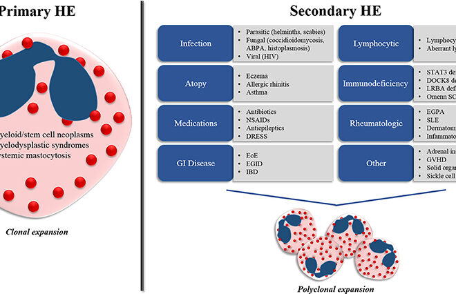 Hypereosinophilic Syndrome (HES): Causes, Symptoms, and Treatments