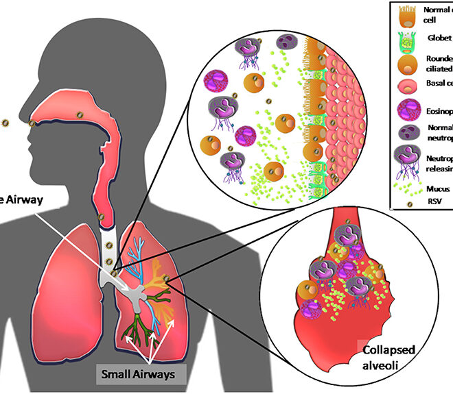 Respiratory Syncytial Virus (RSV): An Overview of Causes, Symptoms, and Care