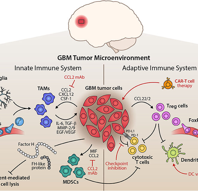 Glioblastoma: Understanding the Most Aggressive Brain Tumor (GBM)