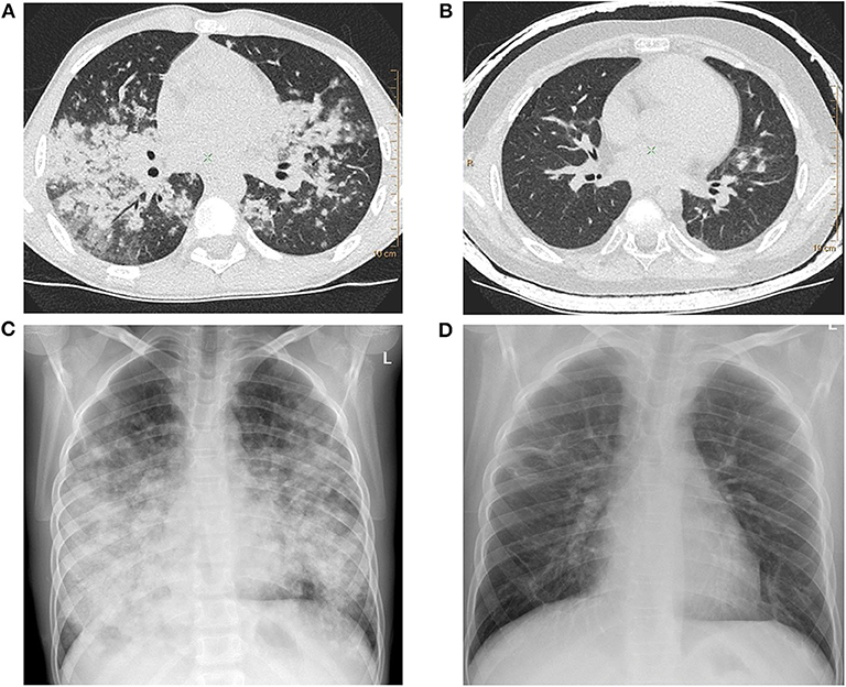 Interstitial Lung Disease: Causes, Symptoms, Diagnosis & Care