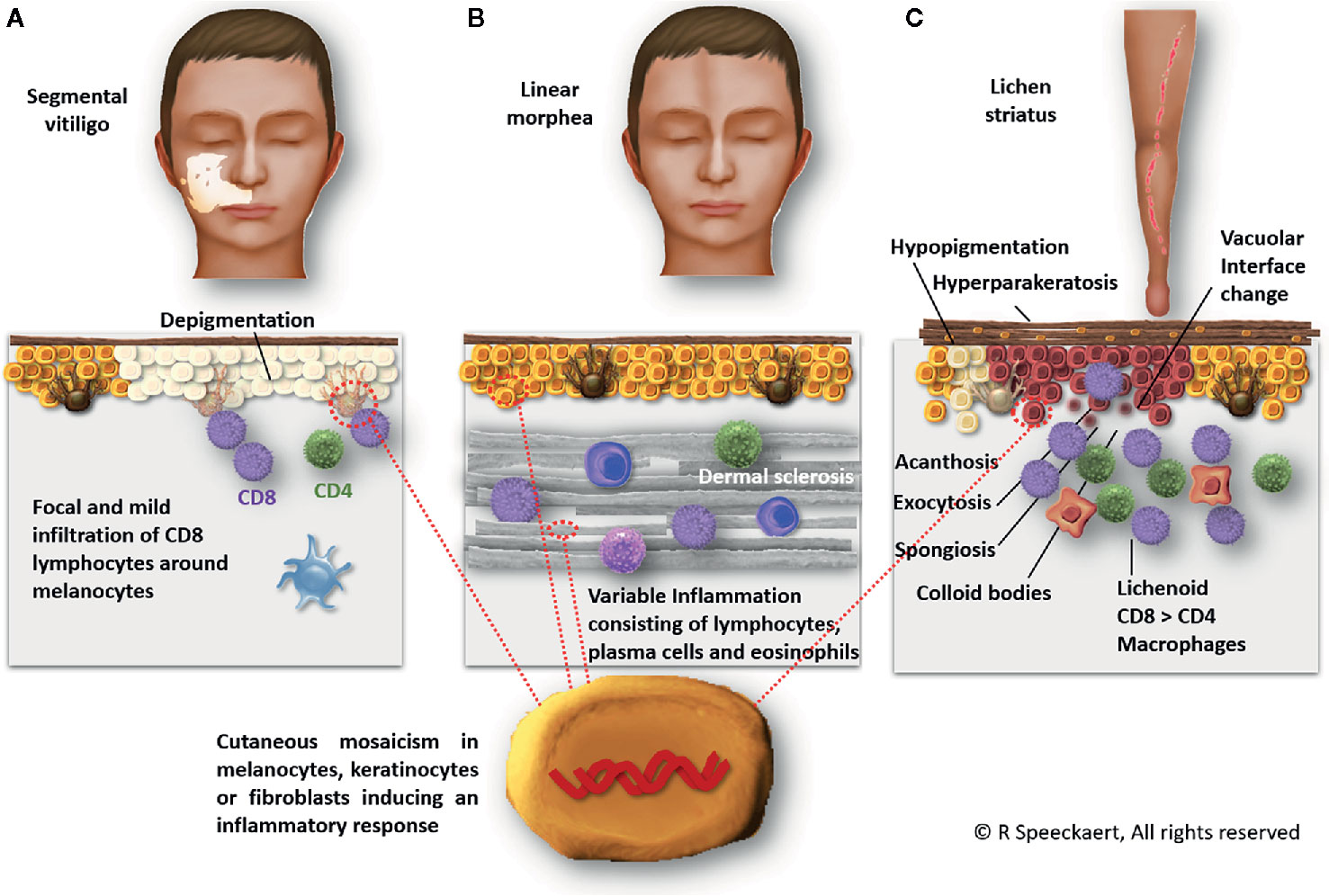 Vitiligo: Understanding the Skin Pigmentation Disorder
