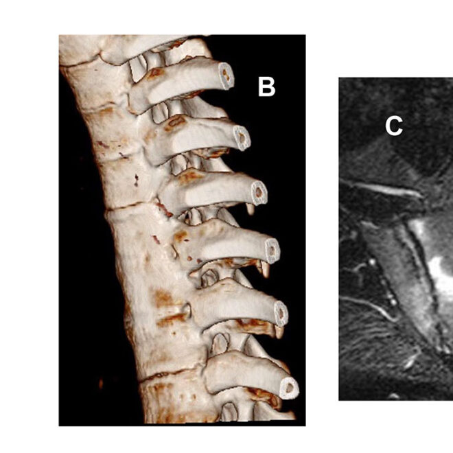 Spondylosis: Understanding Spinal Degeneration and Its Effects