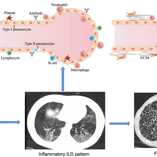 Interstitial Lung Disease: Causes, Symptoms, Diagnosis & Care
